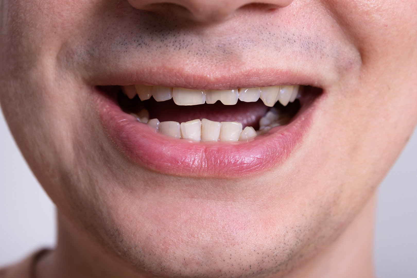 Broken Tooth Treatment