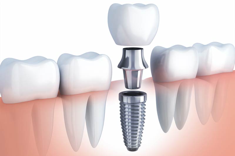 Implants Dentist in Katy
